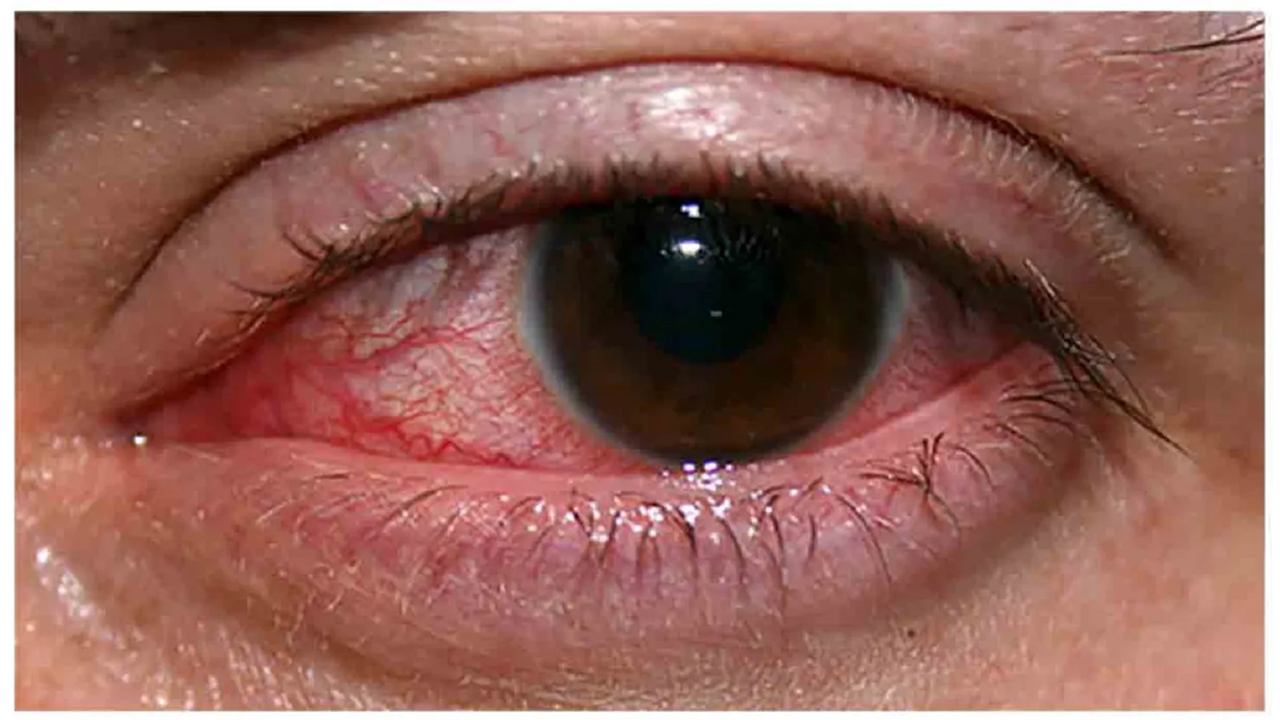 बर्षातको समयमा आँखामा हुन्छ यस्तो सरुवा रोग, अपनाउनुहोस् घरेलु उपाय