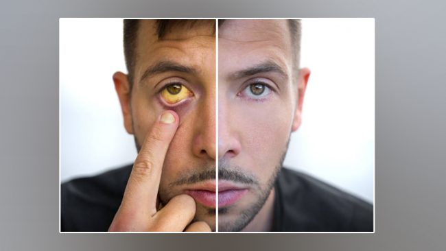 जन्डिस किन हुन्छ, जान्नुहोस् लक्षण र बच्ने उपाय