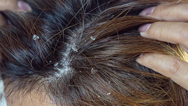 टाउकोमा फङ्गल इन्फेक्सन भएको छ ?, बच्न अपनाउनुहोस् यी ५ उपाय