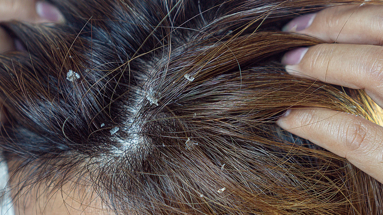 टाउकोमा फङ्गल इन्फेक्सन भएको छ ?, बच्न अपनाउनुहोस् यी ५ उपाय