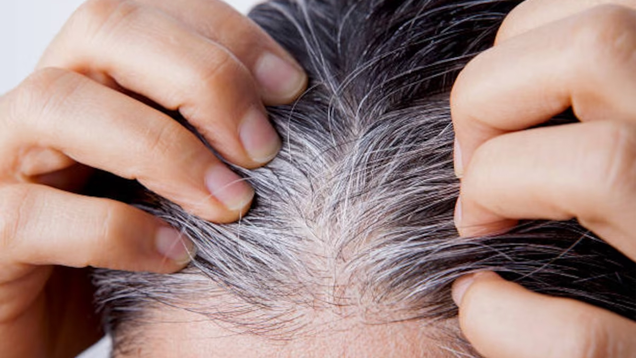 कुन भिटामिनको कमीले कपाल सेतो हुन्छ?