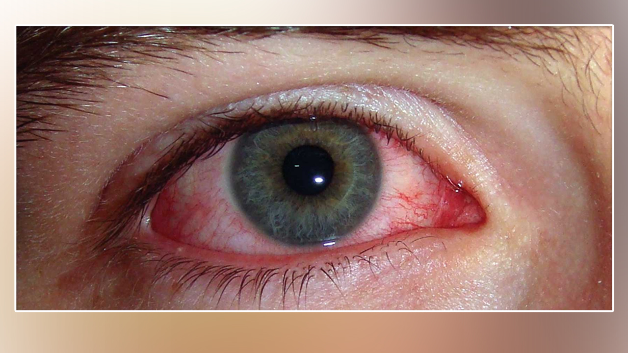 तपाईको पनि आँखा पाक्यो ? यस्ता छन् घरेलु उपाय