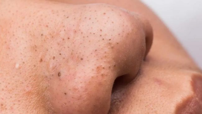 ब्ल्याकहेड्सबाट छुटकारा पाउन यसो गर्नुहोस्