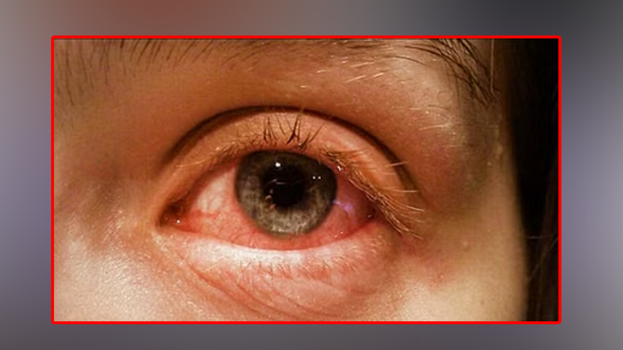 किन फैलिन्छ आँखाको संक्रमण ? आई फ्लू हुँदा के गर्ने र के नगर्ने ?