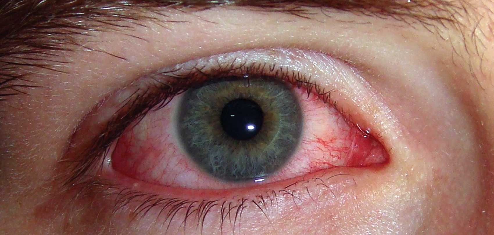 ताप्लेजुङमा आँखा पाक्ने बिरामीको सङ्ख्या बढ्दै