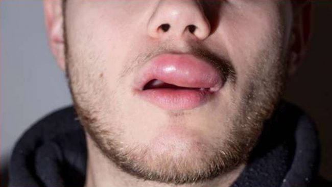 ओठ सुन्निने, चिलाउने र पोल्ने हुन्छ? यसो गर्नुहोस्