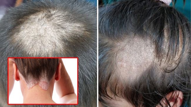 टाउकोमा दाद आएको छ ? रोकथामका लागि यसो गर्नुहोस्।