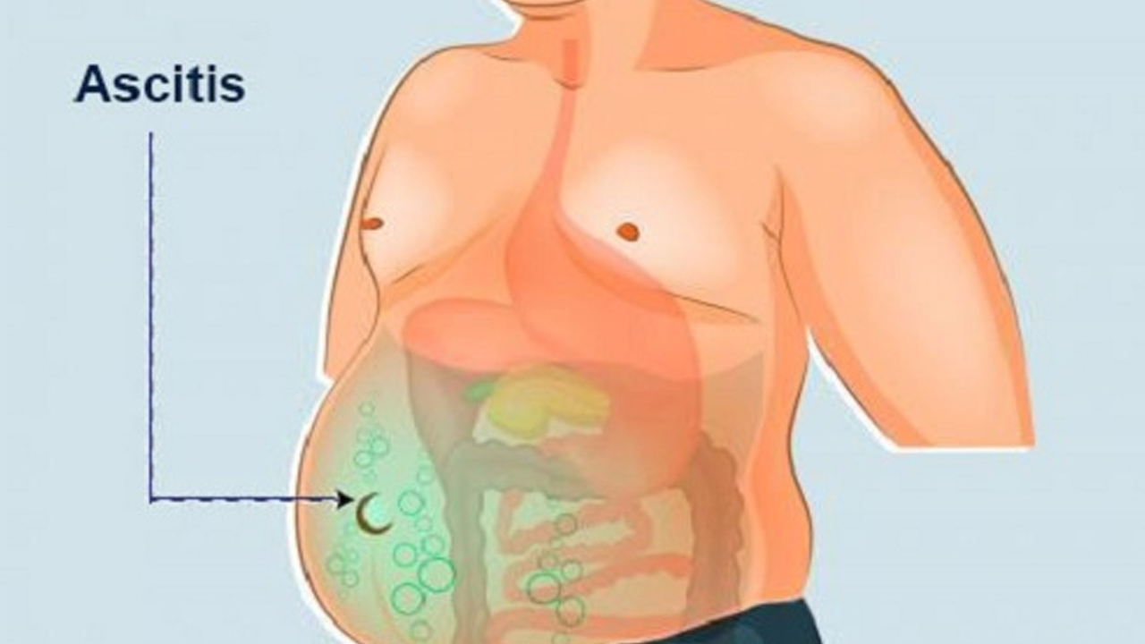 यस रोगका कारण पेटमा भरिन्छ पानी, यस्ता छन् लक्षण