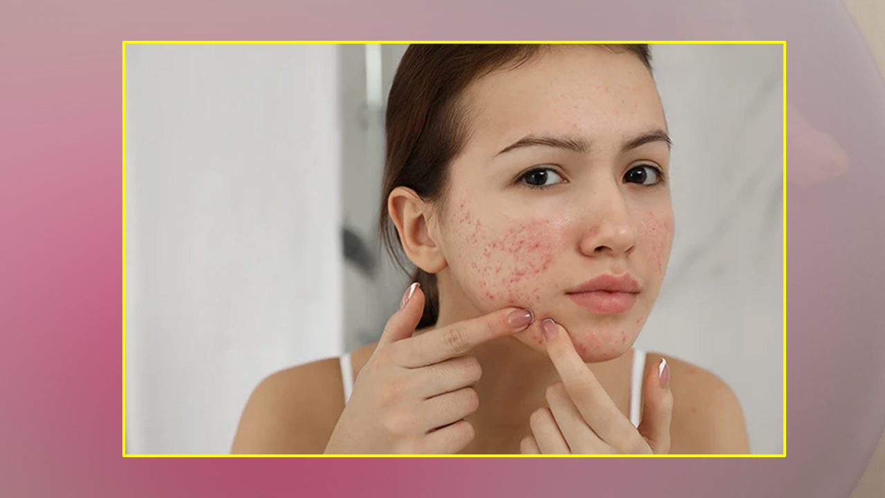 अनुहारमा पिम्पल आएर हैरान हुनुहुन्छ ? यी टिप्स अपनाउनुहोस्