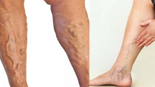 खुट्टामा देखिने निलो नसालाई सामान्य नठान्नुहोस्, यो गम्भीर रोगको सुरुवात हुनसक्छ!