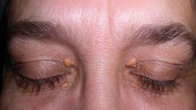 खराब कोलेस्ट्रोल बढ्दा अनुहारमा देखिन सक्छ यी ५ लक्षण