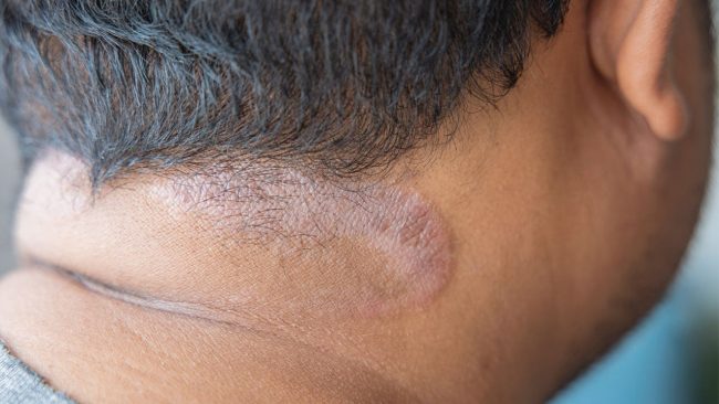 निधार र घाँटीमा यस्तो सेतो दाग आएको छ, यी घरेलु उपाय अपनाउनुहोस्