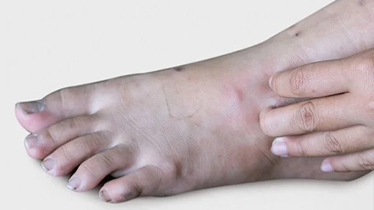 खुट्टामा देखिने यी ५ लक्षण डायबिटीजको लक्षण हुन सक्छ!