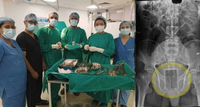उपचारका लागि आएका पुरुषको मलद्वारमा बोतल अड्किएको देखिएपछि…
