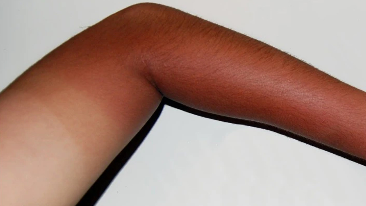 घामले हात डढेर कालो भएको छ ? यसरी हटाउनुहोस्