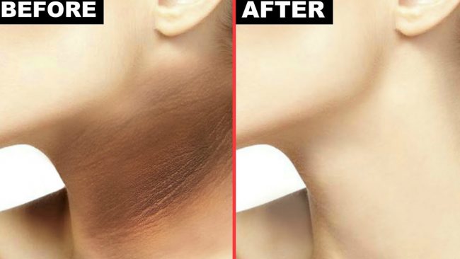 गर्दन कालो भएर लुकाइरहनुभएको छ ? यसो गर्नुहोस्