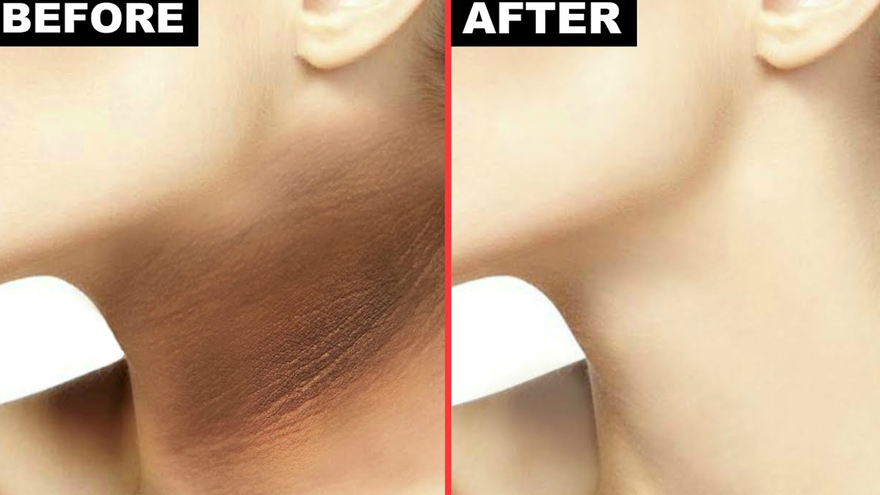 गर्दन कालो भएर लुकाइरहनुभएको छ ? यसो गर्नुहोस्