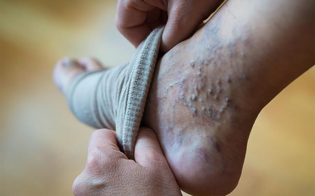 यदि खुट्टामा निलो नसा निस्किरहेको छ भने अपनाउनुहोस् यी ३ उपाय