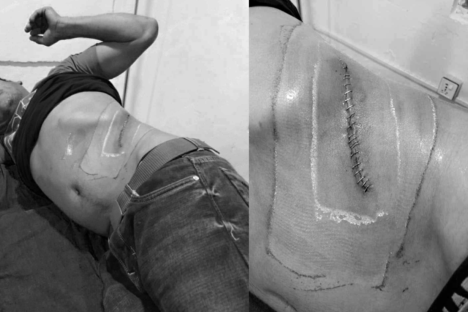 नेपाली युवालाई भारत पुर्‍याएर मिर्गौला झिकियो, तीन जना पक्राउ – Dcnepal